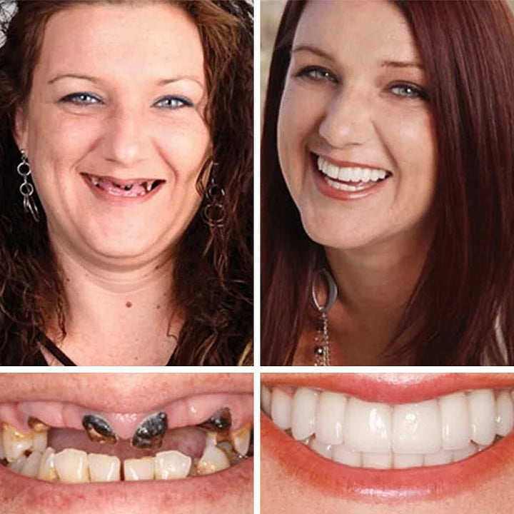 Ends Today: 70% OFF! ⏰70% OFF! EETTSY™ Medical Full Denture with Strong Suctiond Custom-Fit Full Functional Dentures🦷Obtain American Dental Association (ADA) Certification